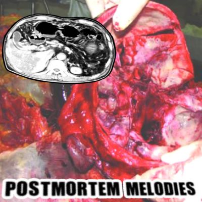 Xanthogranulomatous Pyelonephritis - Postmortem Melodies